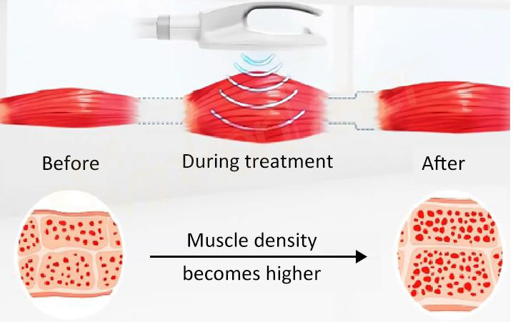 EMS Sculpting Electromagnétique - muscles - Medical Aesthetics Grimbergen